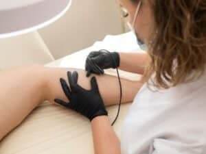 elettrocoagulazione depilazione su gambe