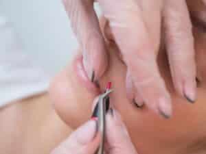 elettrolisi per epilazione viso