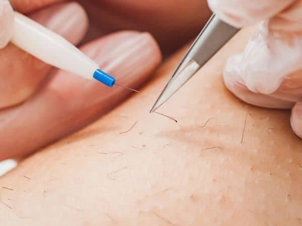epilazione elettrocoagulazione