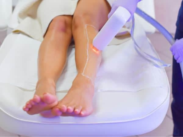 epilazione laser diodi su gambe