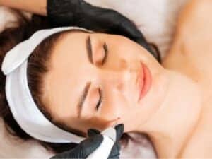 epilazione con ago su viso